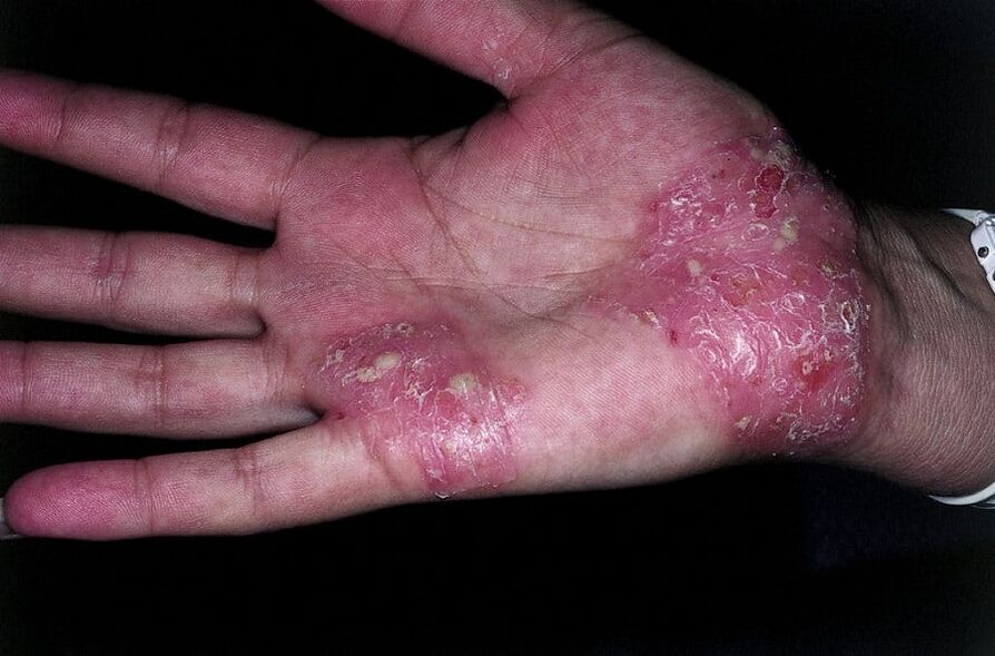 Worsening of hand psoriasis