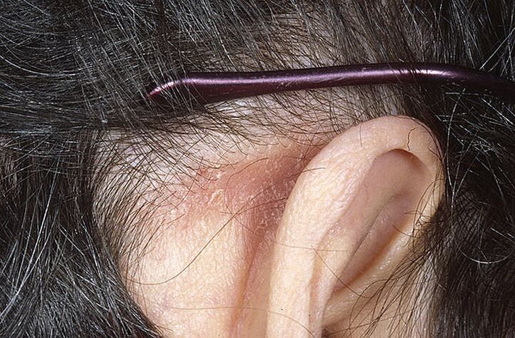 Psoriasis plaque behind ear