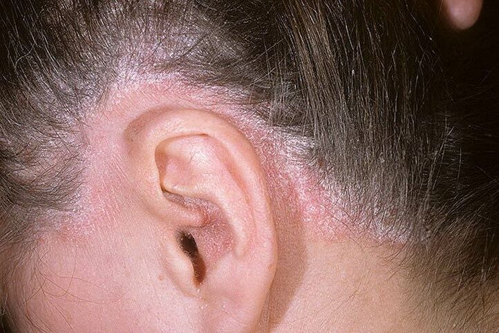 psoriasis behind ear