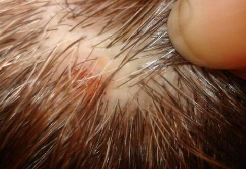 psoriasis on scalp