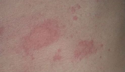 psoriasis with red spots