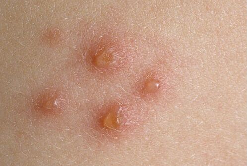 skin nodules of psoriasis