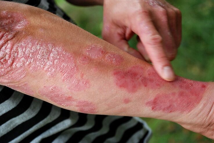 Psoriatic plaques on arms