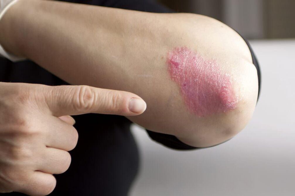Early symptoms of elbow psoriasis