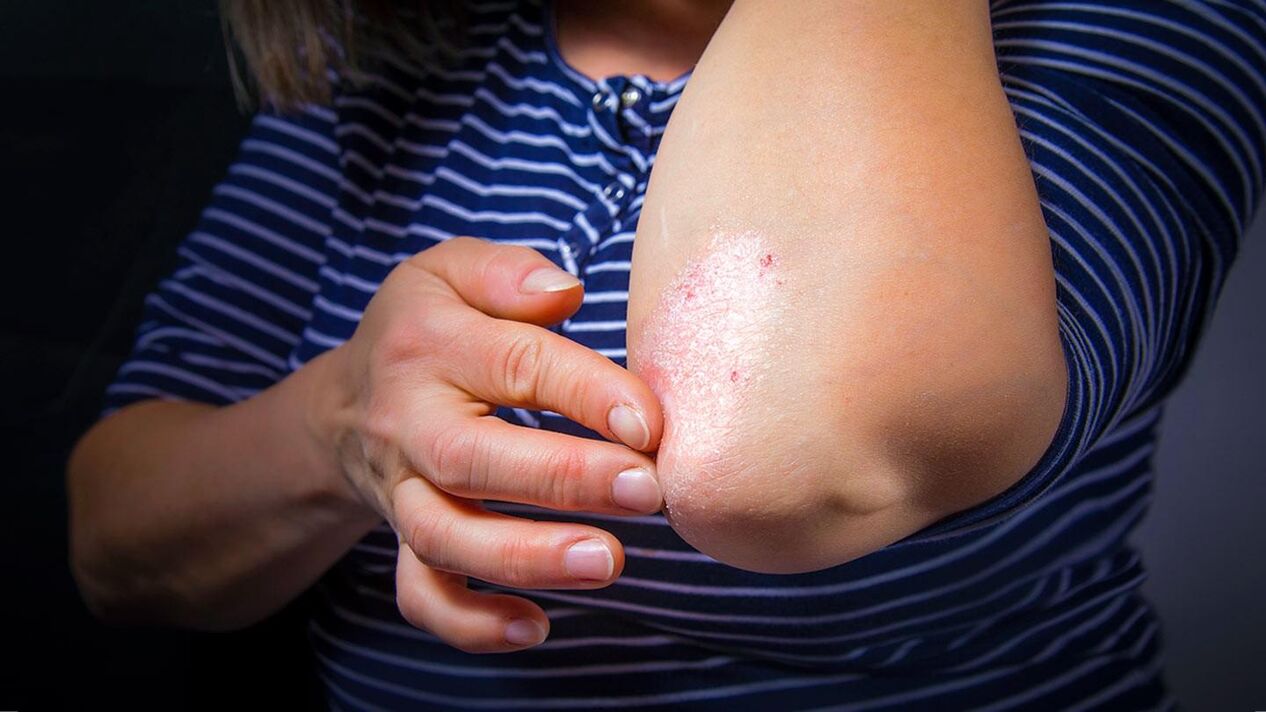 Using ointments can help get rid of psoriasis on your elbows