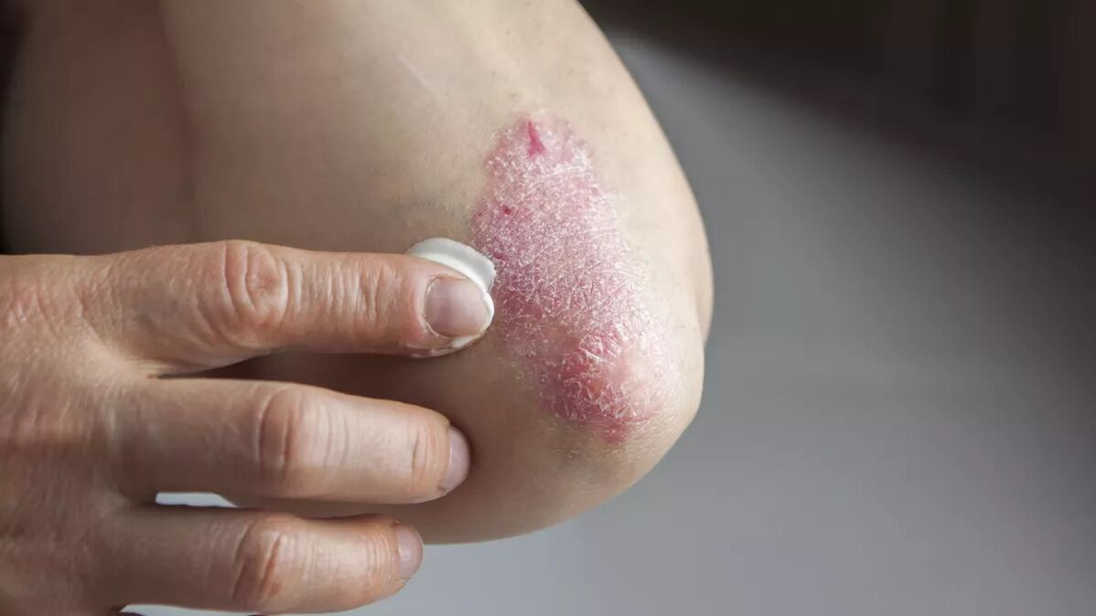 Cream to treat psoriasis patches on elbows
