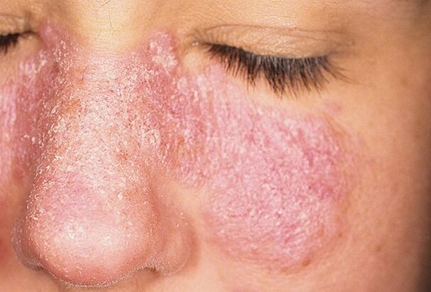 Progressive stages of facial skin psoriasis