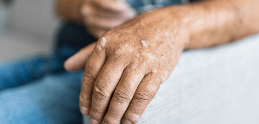 Psoriasis on the skin of hands