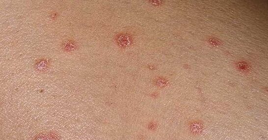 Psoriasis plaques