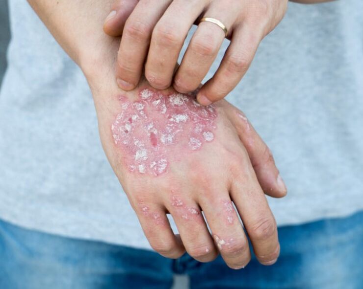 Psoriasis