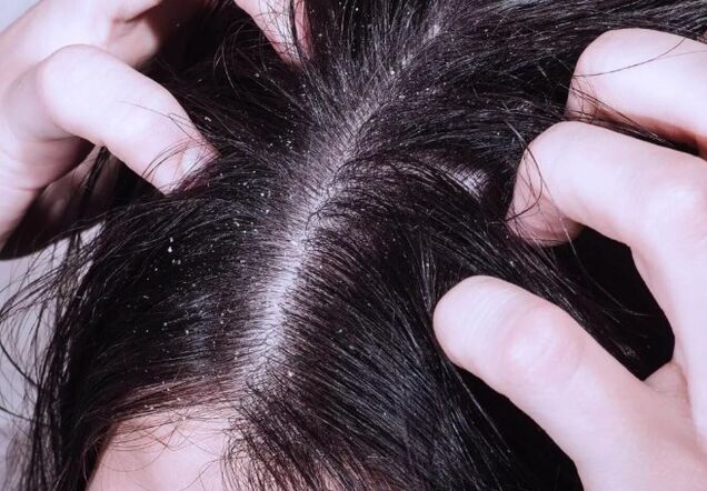 Psoriasis