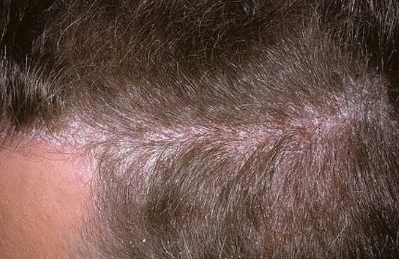 Psoriasis