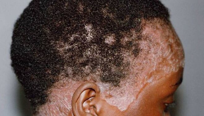 Psoriasis
