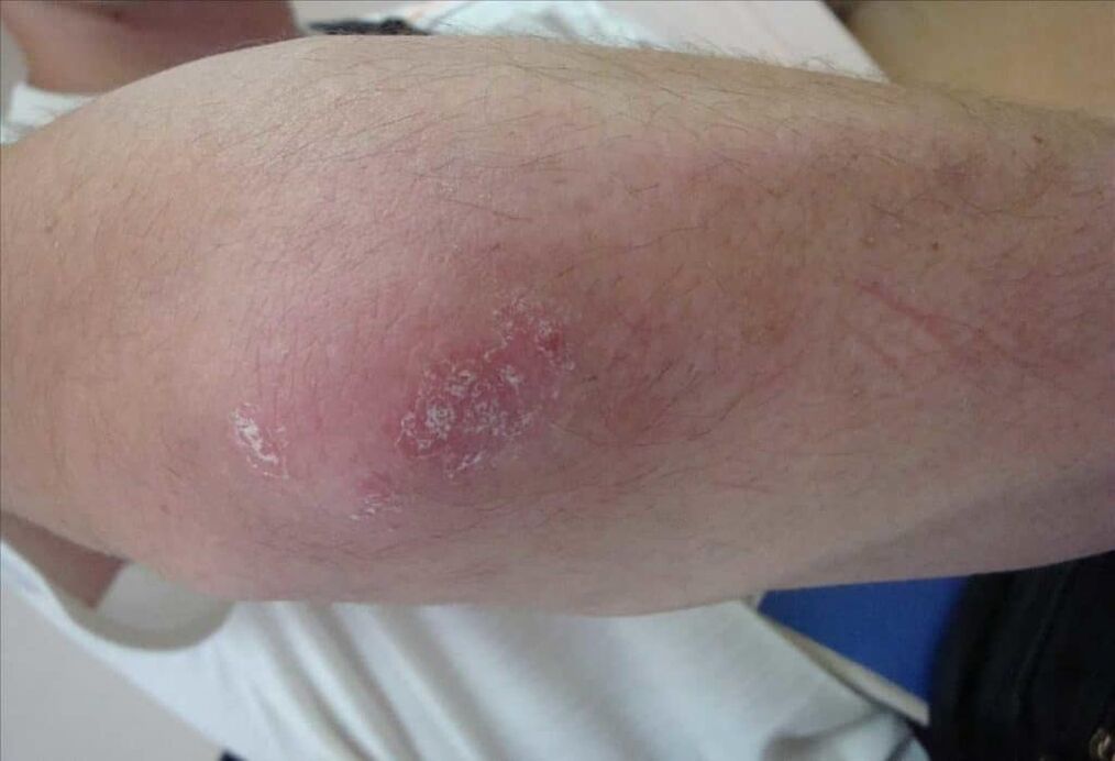 What is psoriasis like