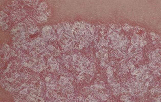 The cure of papules