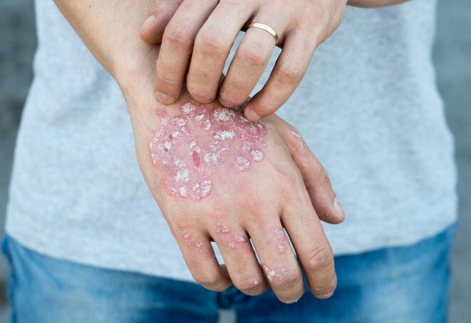 mesnichered psoriasis