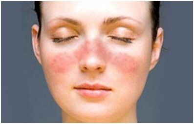 Psoriasis