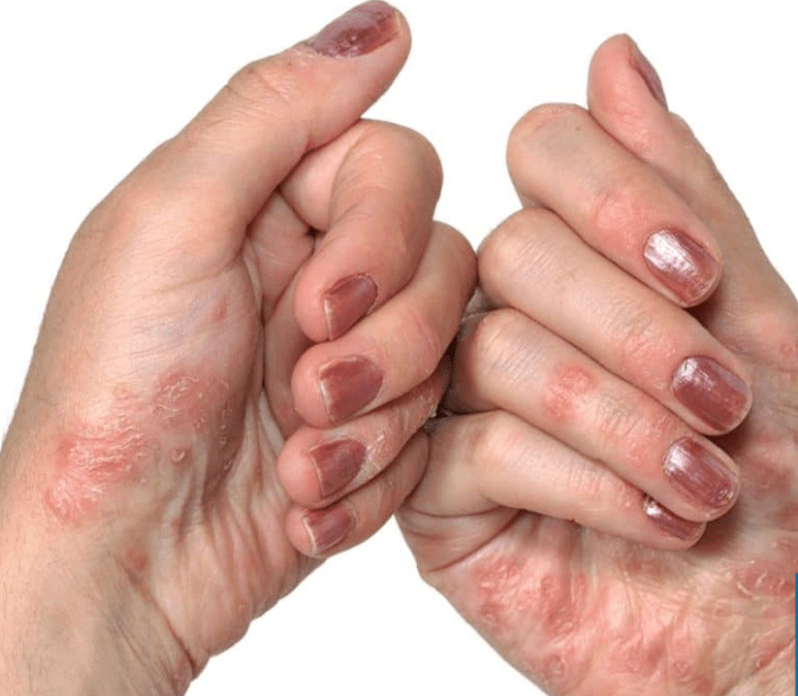 Psoriasis