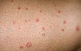 Psoriasis plaques