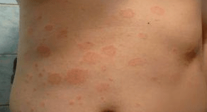 Unfortunately psoriasis