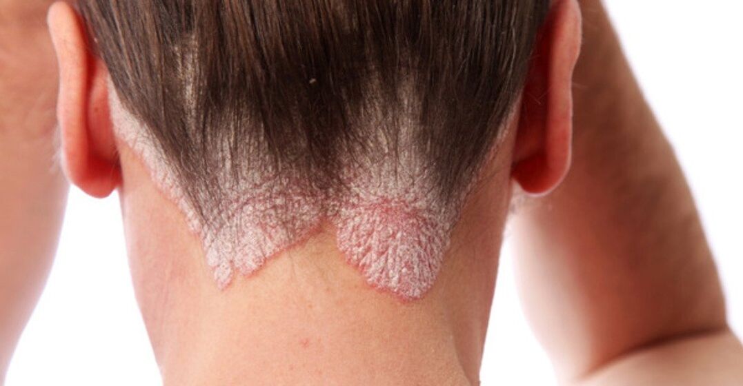 Psoriasis on girl's head