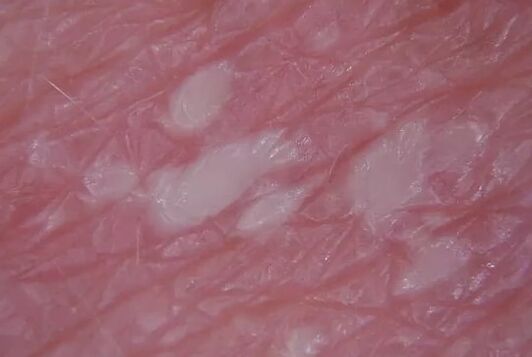 Pustules Pustules