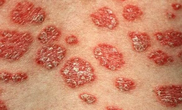 Form of psoriasis