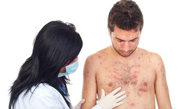 Psoriasis photos