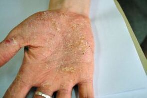 Psoriasis