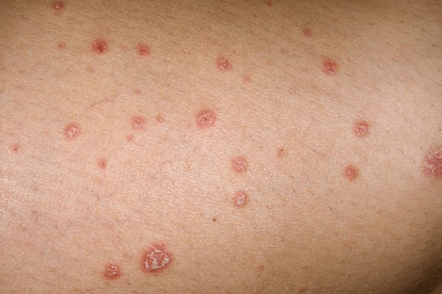 psoriatic plaques