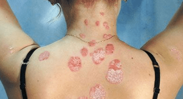 psoriasis