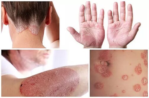 How psoriasis appears on different parts of the body