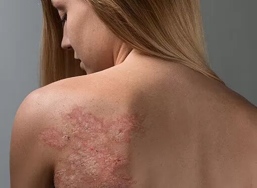 Psoriasis on girls’ backs