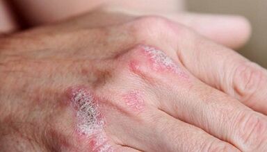 Early symptoms of psoriasis