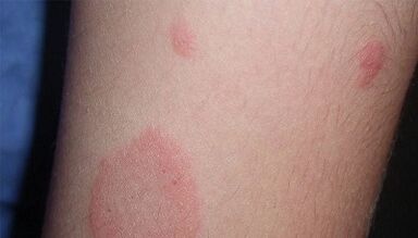 What are the early symptoms of psoriasis