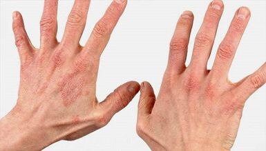 What does the early stages of psoriasis look like