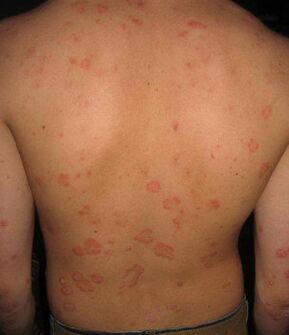 psoriasis on back