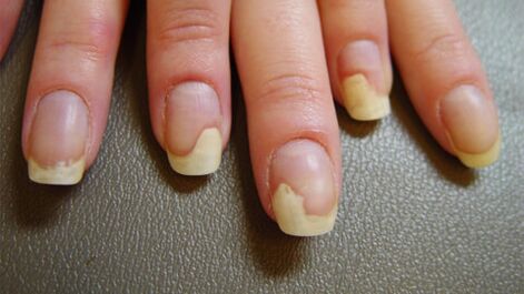 Psoriasis causes white spots on nails
