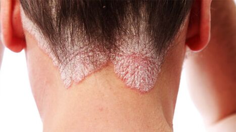 psoriasis plaques on scalp