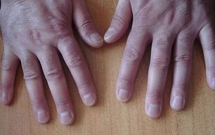 Early symptoms of psoriasis