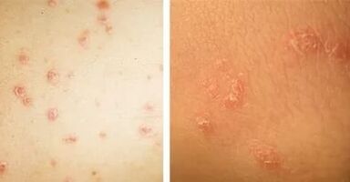 Main manifestations of psoriasis