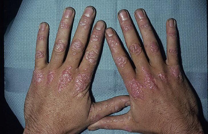 Causes of psoriasis on hands