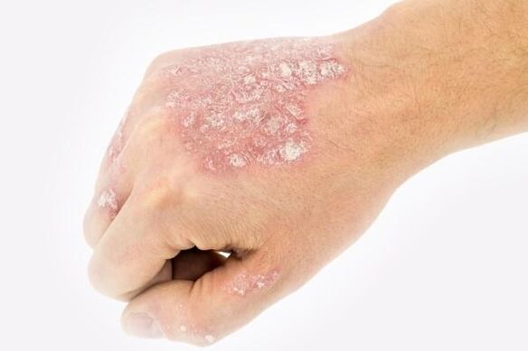 The mechanism of hand psoriasis