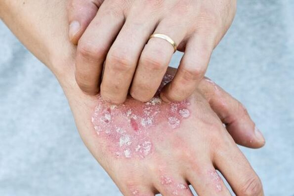 Typical symptoms of hand psoriasis