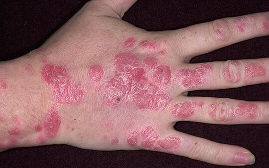 Psoriasis plaques on hands