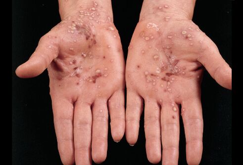 What does psoriasis look like on the palm of your hand