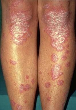 Manifestations of leg psoriasis