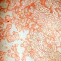 Psoriasis plaques on the body