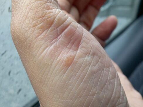 Photo of psoriasis on hands
