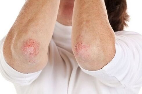 Manifestations of elbow psoriasis
